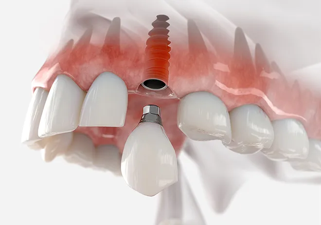 骨の少ない方への治療