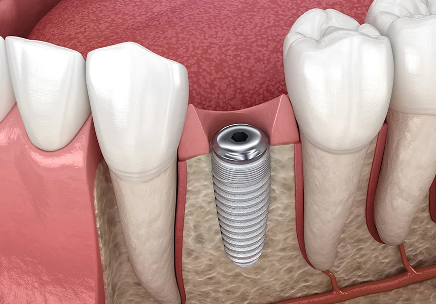 1次手術（インプラントの埋入）