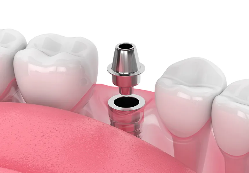 2次手術（アバットメントの装着）