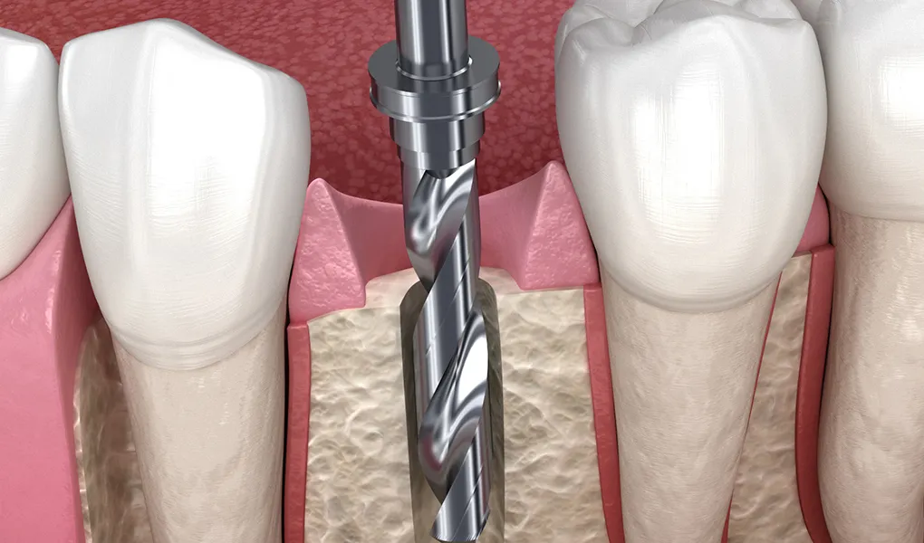 デンサーバーとは