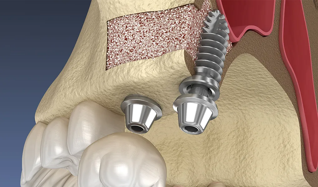 ソケットリフト