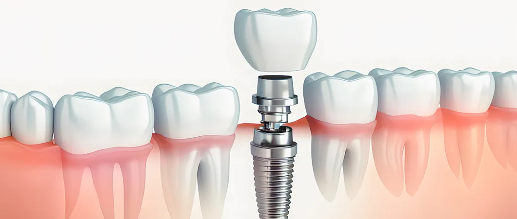 インプラント治療とは