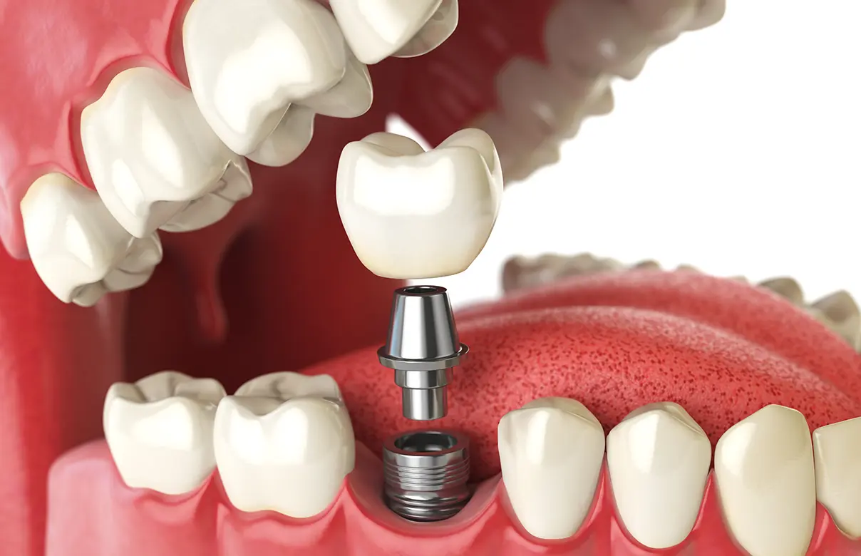 インプラント治療の流れ