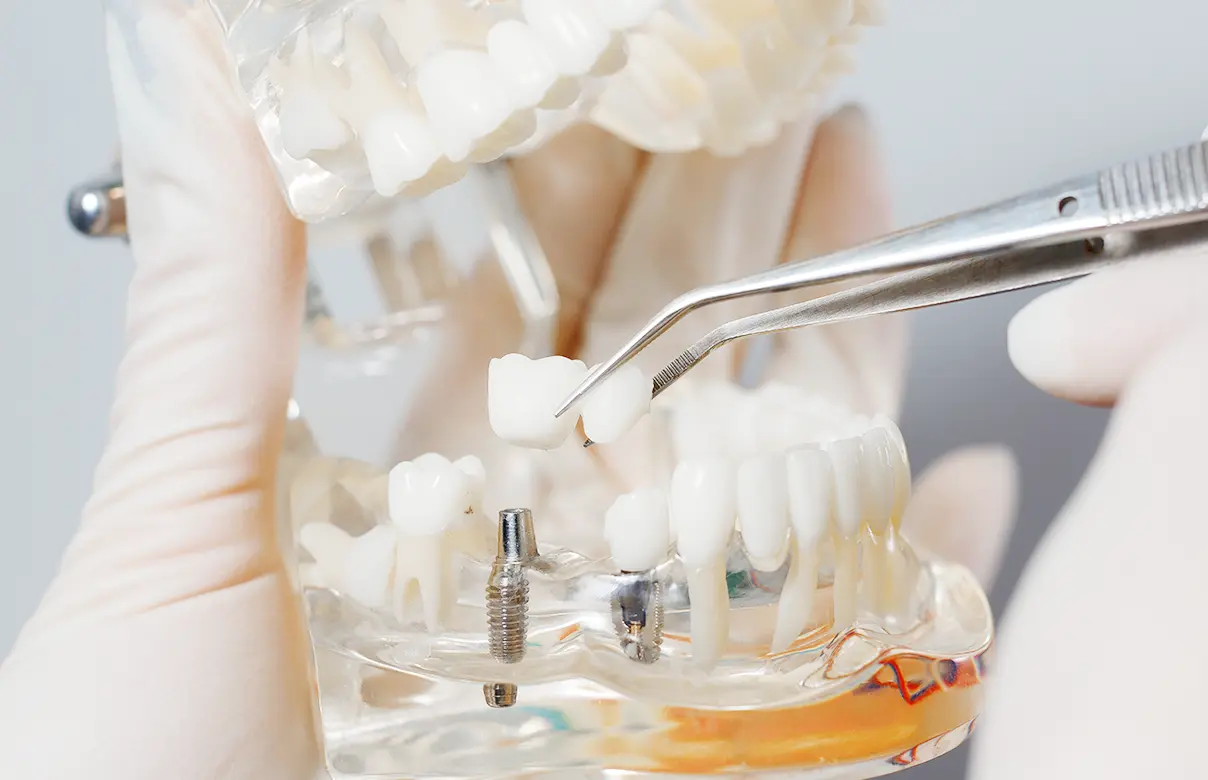 さまざまなインプラント治療