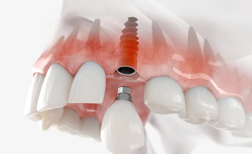 骨の少ない方への治療