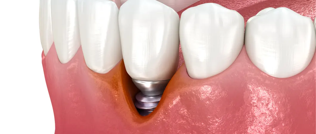 インプラント周囲炎