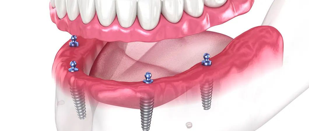 インプラントオーバーデンチャー