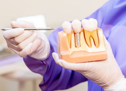 平塚でインプラントを後悔しないために。歯科医院選びで外せない3つの基準｜中原グリーン歯科